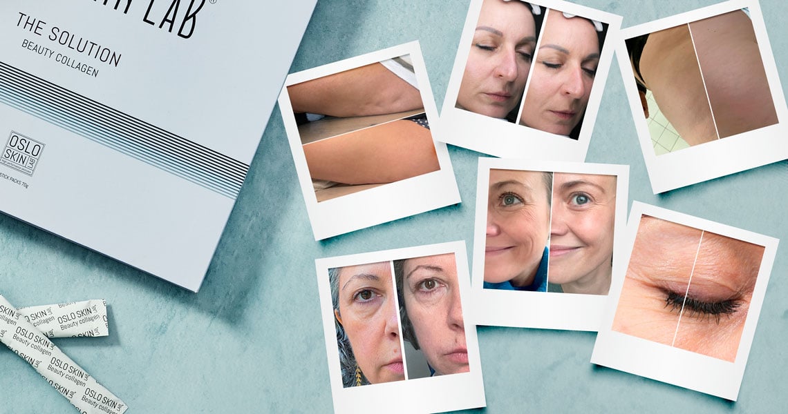 Kollage av före- och efterbilder som visar resultatet av Oslo Skin Labs kollagenpulver.